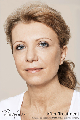 Woman after Restylane cheek treatment