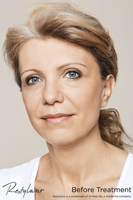 Woman before Restylane cheek treatment