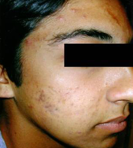 Woman after acne treatment