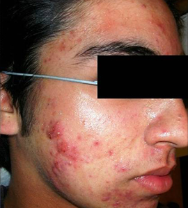 Woman before acne treatment