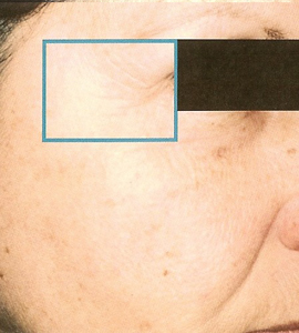 Woman after wrinkle treatment