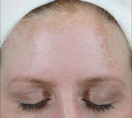 Woman after skin treatment