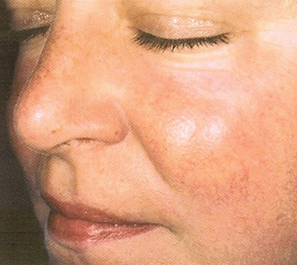 Woman after skin treatment