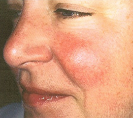 Woman before rosacea treatment