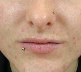 Woman after acne treatment