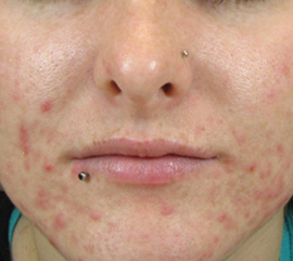 Woman before acne treatment