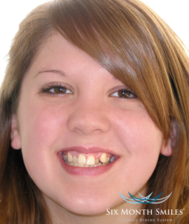 Woman before Six Month Smiles teeth straightening treatment