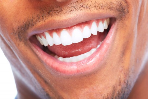 Professional Teeth Whitening in Teddington