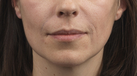 Woman after Restylane lip treatment