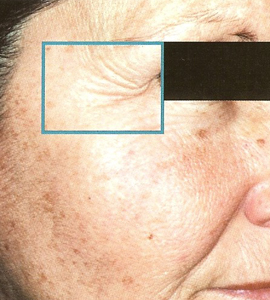 Woman before skin treatment