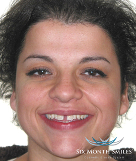 Woman before Six Month Smiles teeth straightening treatment